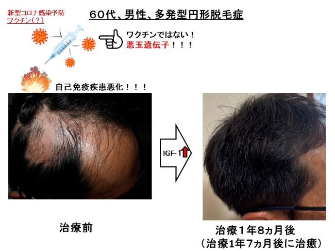 円形脱毛症　病院